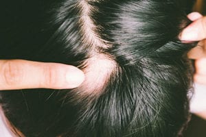 How To Stop Balding and Thinning and Gray Hair